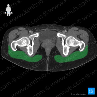 Músculo glúteo máximo (Musculus gluteus maximus); Imagem: 