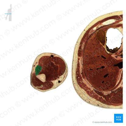 Músculo extensor radial longo do carpo (Musculus extensor carpi radialis longus); Imagem: National Library of Medicine