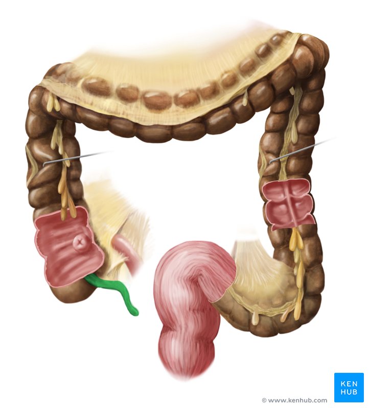 Appendicitis Symptoms Clinical Signs And Management Kenhub