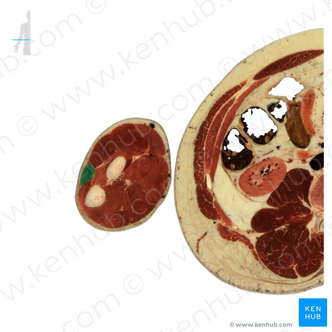 Musculus extensor carpi ulnaris (Ellenseitiger Handstrecker); Bild: National Library of Medicine