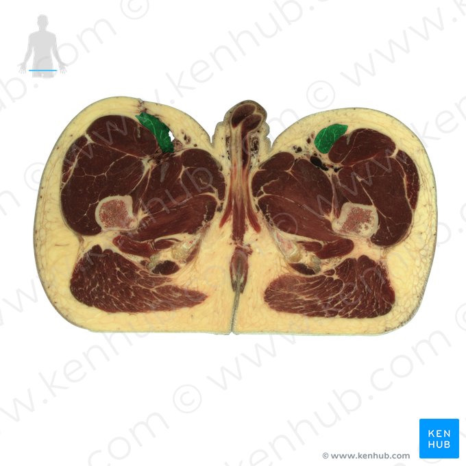 Sartorius muscle (Musculus sartorius); Image: National Library of Medicine