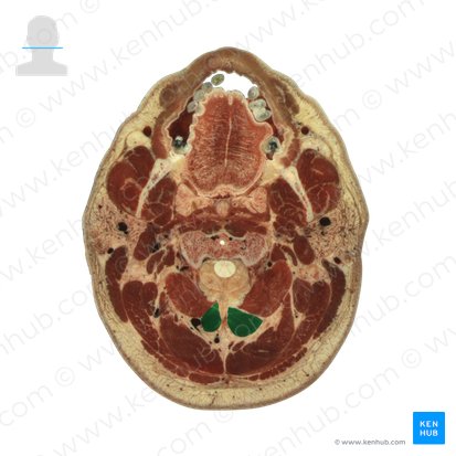 Músculo reto posterior maior da cabeça (Musculus rectus capitis posterior major); Imagem: National Library of Medicine