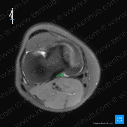 Posterior cruciate ligament (Ligamentum cruciatum posterius); Image: 