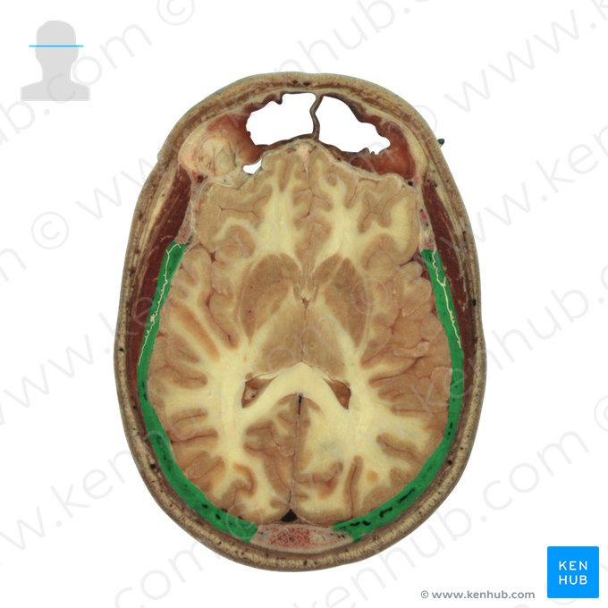 Osso parietal (Os parietale); Imagem: National Library of Medicine