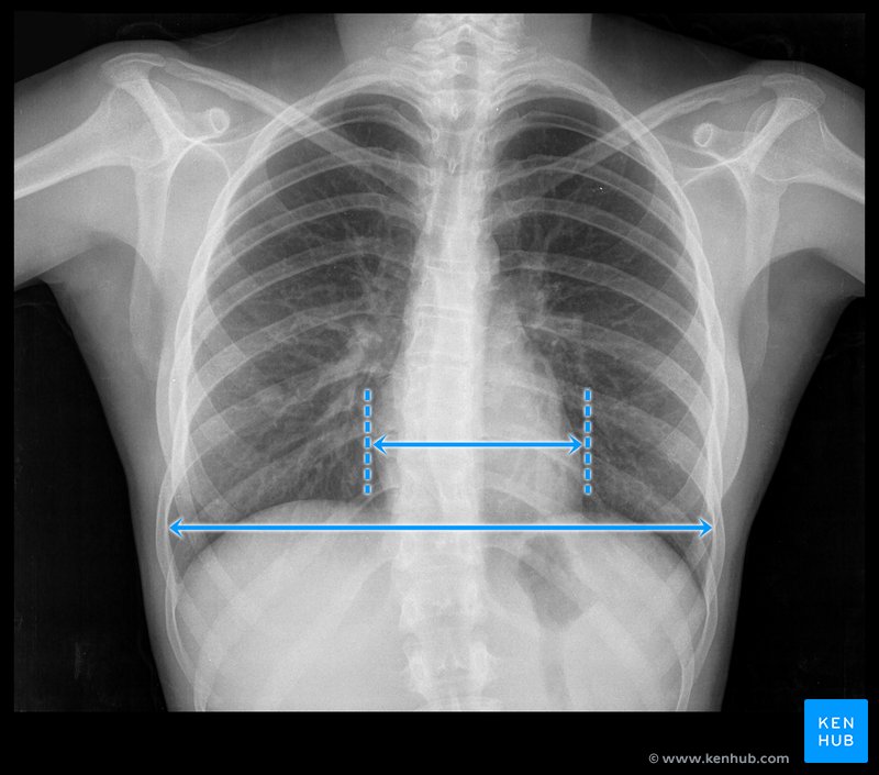 Chest X-ray - cardiothoracic ratio