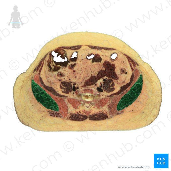 Musculus gluteus medius (Mittlerer Gesäßmuskel); Bild: National Library of Medicine