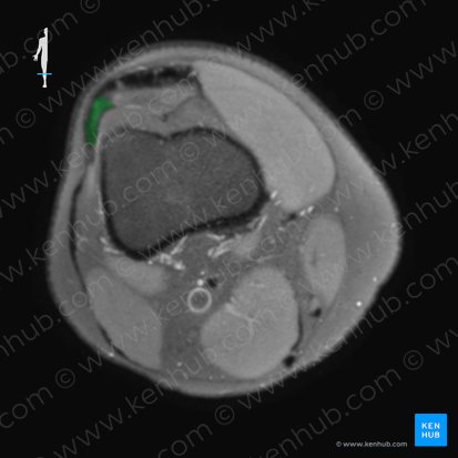 Tendon of vastus lateralis muscle (Tendo musculi vasti lateralis); Image: 