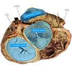 Clinical case: Long ectopic left main coronary artery