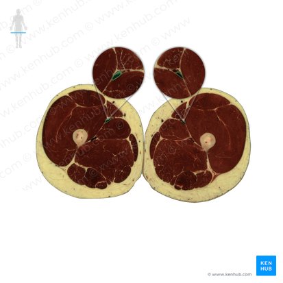 Vena femoralis (Oberschenkelvene); Bild: National Library of Medicine