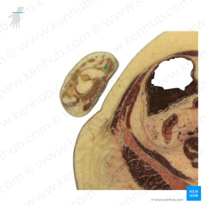Processus styloideus radii (Griffelfortsatz der Speiche); Bild: National Library of Medicine