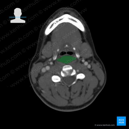 Laryngopharynx (Pars laryngea pharyngis); Image: 