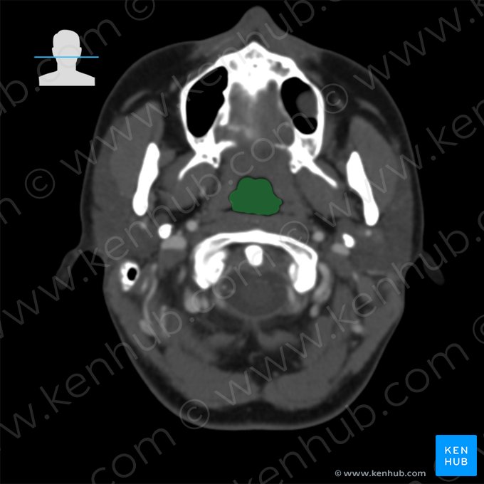 Nasopharynx (Pars nasalis pharyngis); Image : 