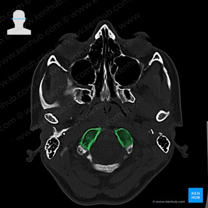 Occipital condyle (Condylus occipitalis); Image: 