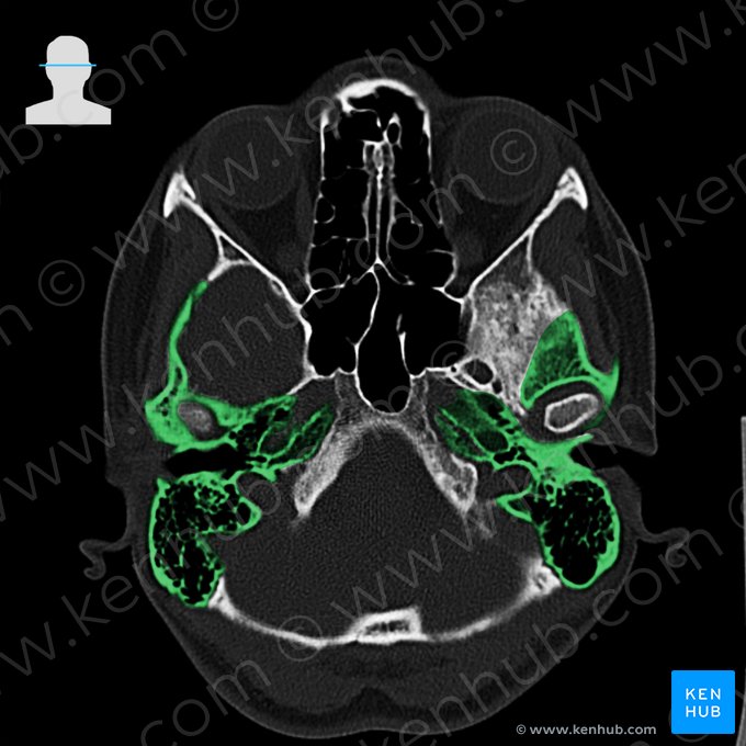 Temporal bone (Os temporale); Image: 