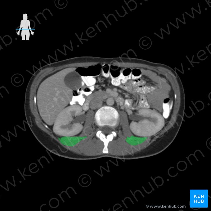 Musculus quadratus lumborum (Viereckiger Lendenmuskel); Bild: 