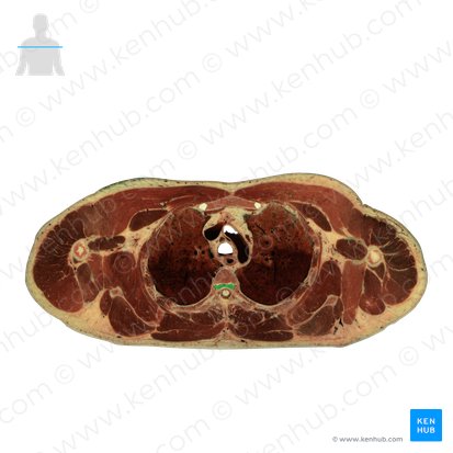 Intervertebral disc (Discus intervertebralis); Image: National Library of Medicine