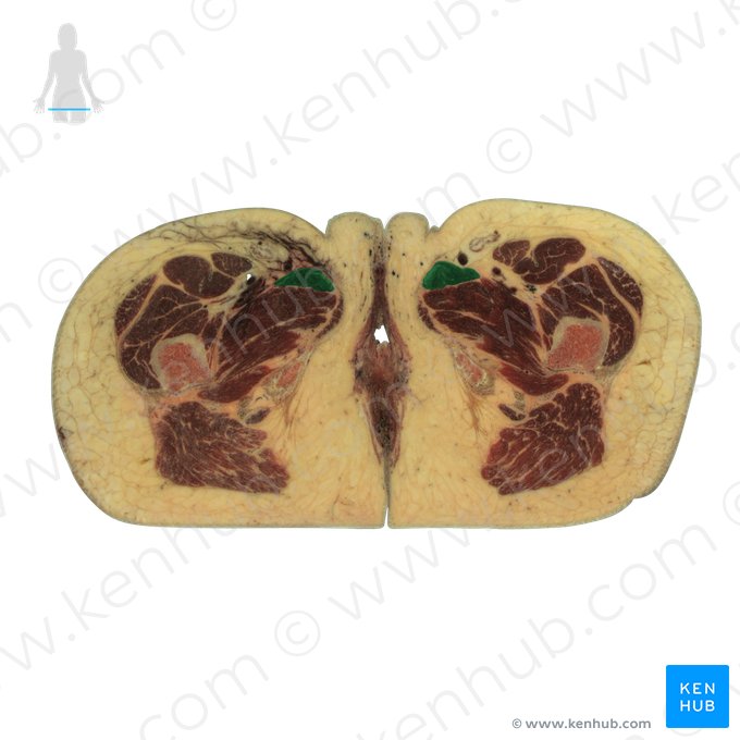 Musculus adductor longus (Langer Oberschenkelanzieher); Bild: National Library of Medicine