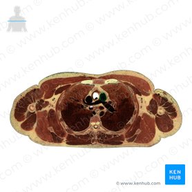 Tronco pulmonar (Truncus pulmonalis); Imagen: National Library of Medicine