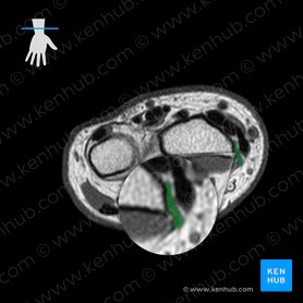 Tendão do músculo braquiorradial (Tendo musculi brachioradialis); Imagem: 
