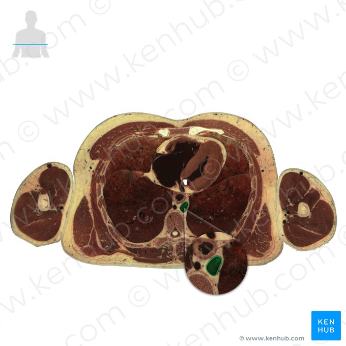 Aorta thoracica descendens (Absteigende Brustaorta); Bild: National Library of Medicine