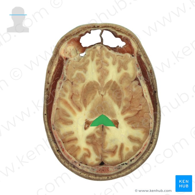 Splenium of corpus callosum (Splenium corporis callosi); Image: National Library of Medicine