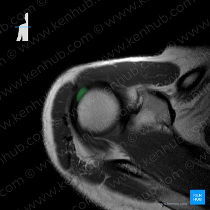 Tendon of supraspinatus muscle (Tendo musculi supraspinati); Image: 