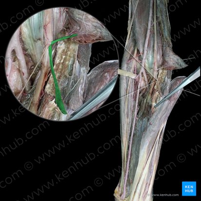 Rameaux musculaires du nerf médian pour le muscle fléchisseur radial du carpe (Rami musculares nervi mediani cum musculus flexor carpi radialis); Image : 