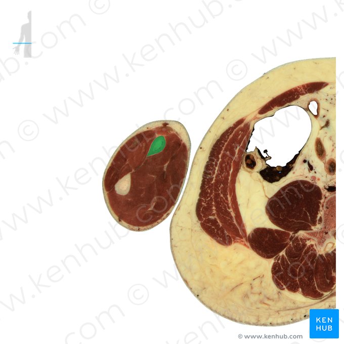 Rádio (Radius); Imagem: National Library of Medicine