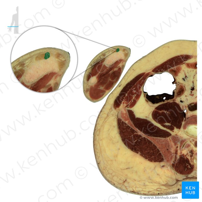 Musculus extensor carpi radialis longus (Langer speichenseitiger Handstrecker); Bild: National Library of Medicine