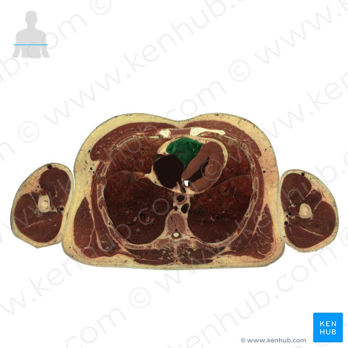 Right ventricle of heart (Ventriculus dexter cordis); Image: National Library of Medicine