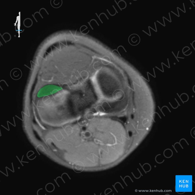 Asta anterior del menisco lateral (Cornu anterius menisci lateralis); Imagen: 