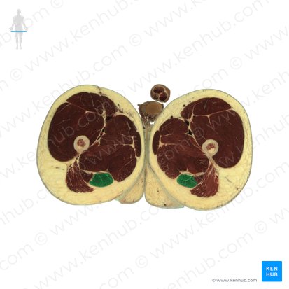 Musculus semitendinosus (Halbsehnenmuskel); Bild: National Library of Medicine