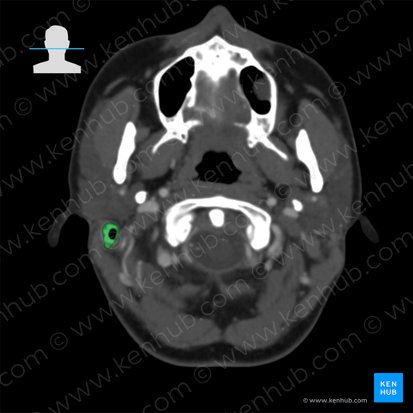 Mastoid process of temporal bone (Processus mastoideus ossis temporalis); Image: 