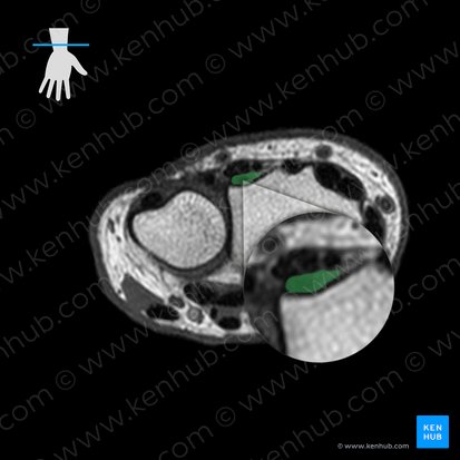 Tendon of extensor indicis muscle (Tendo musculi extensor indicis); Image: 