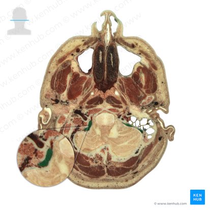 Sigmoid sinus (Sinus sigmoideus); Image: National Library of Medicine