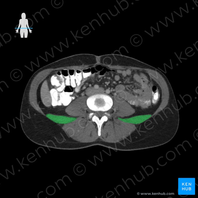 Musculus quadratus lumborum (Viereckiger Lendenmuskel); Bild: 