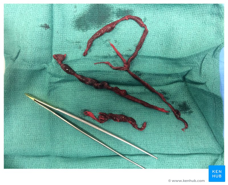 Removed clot