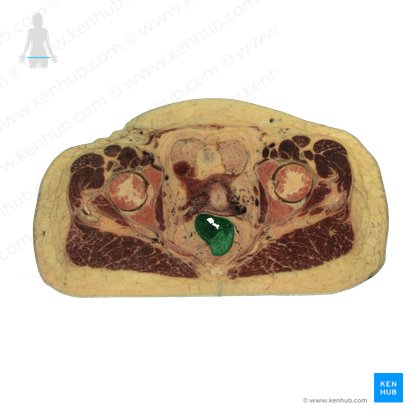 Colon sigmoideum (Sigmoid); Bild: National Library of Medicine