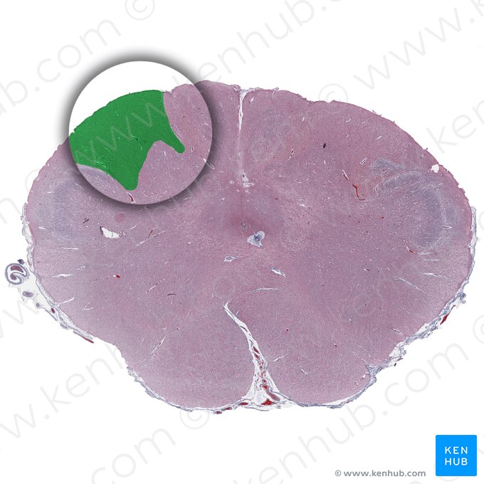 Fascículo cuneiforme (Fasciculus cuneatus); Imagem: 