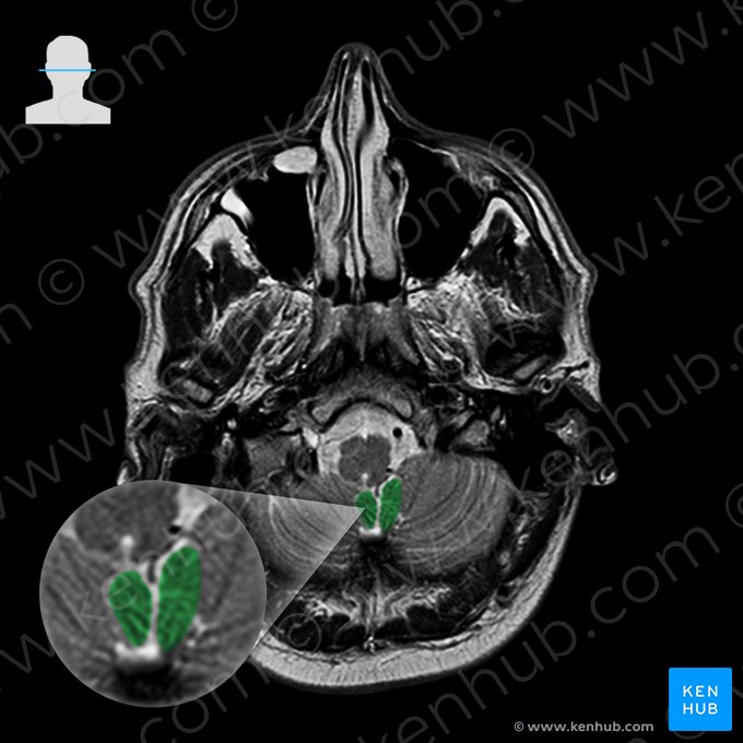 Tonsil of cerebellum (Tonsilla cerebelli); Image: 