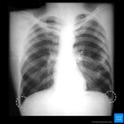 Clinical case: Penetration of the pericardium