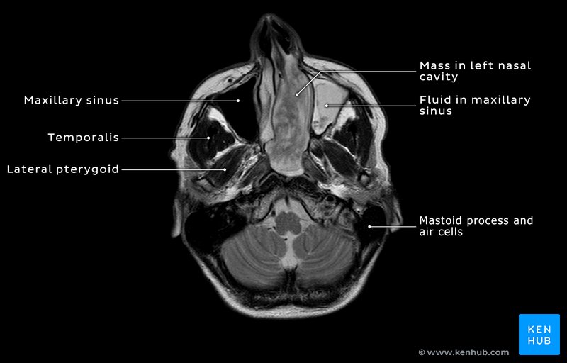 Tumoral mass in the nasal cavity - axial T2 MRI