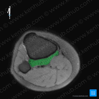 Popliteus muscle (Musculus popliteus); Image: 