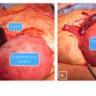 Clinical case: Ovarian torsion