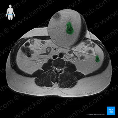 Descending colon (Colon descendens); Image: 