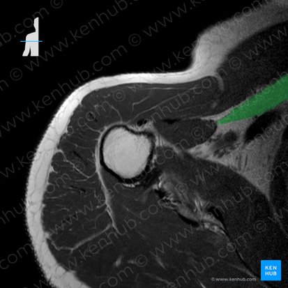 Pectoralis minor muscle (Musculus pectoralis minor); Image: 