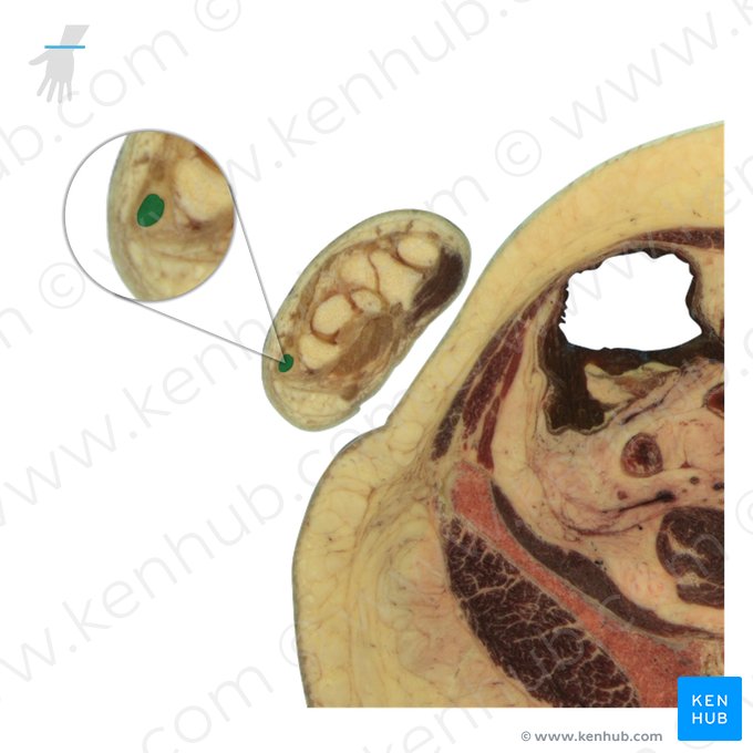 Tendon of extensor carpi ulnaris muscle (Tendo musculi extensoris carpi ulnaris); Image: National Library of Medicine