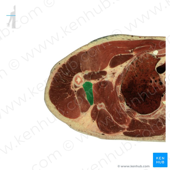 Teres major muscle (Musculus teres major); Image: National Library of Medicine