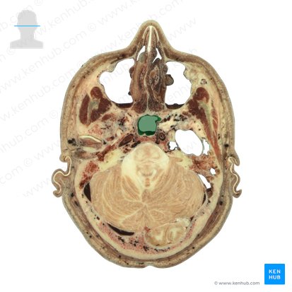 Sinus sphenoidalis (Keilbeinhöhle); Bild: National Library of Medicine