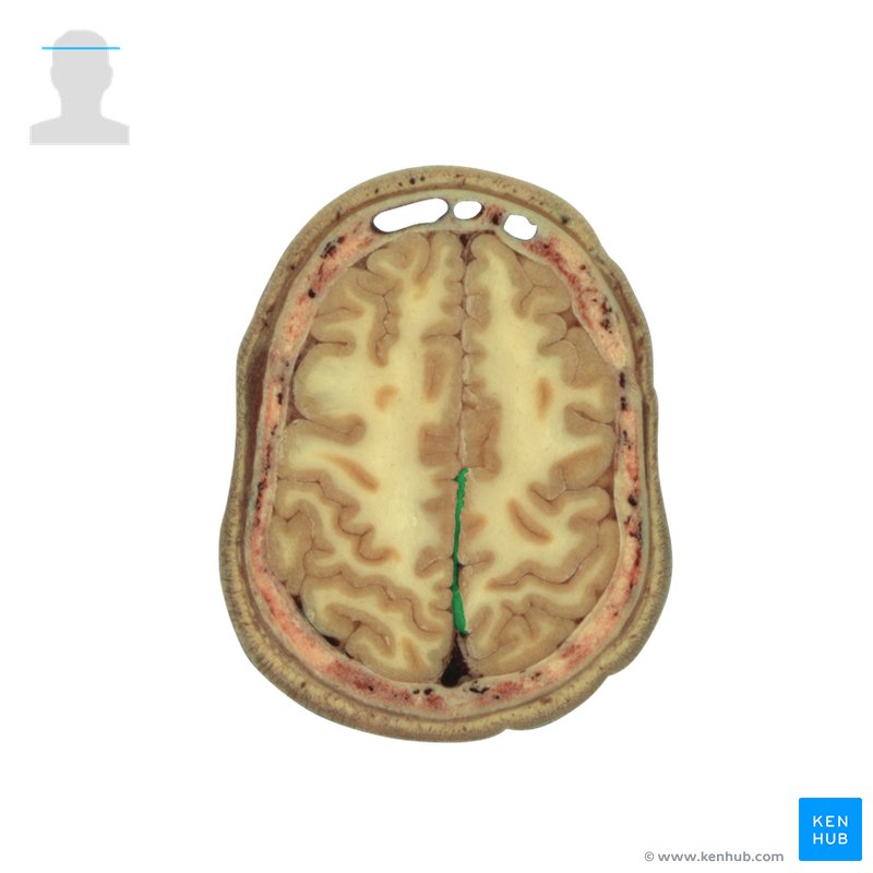 Cerebral falx - cross-sectional view